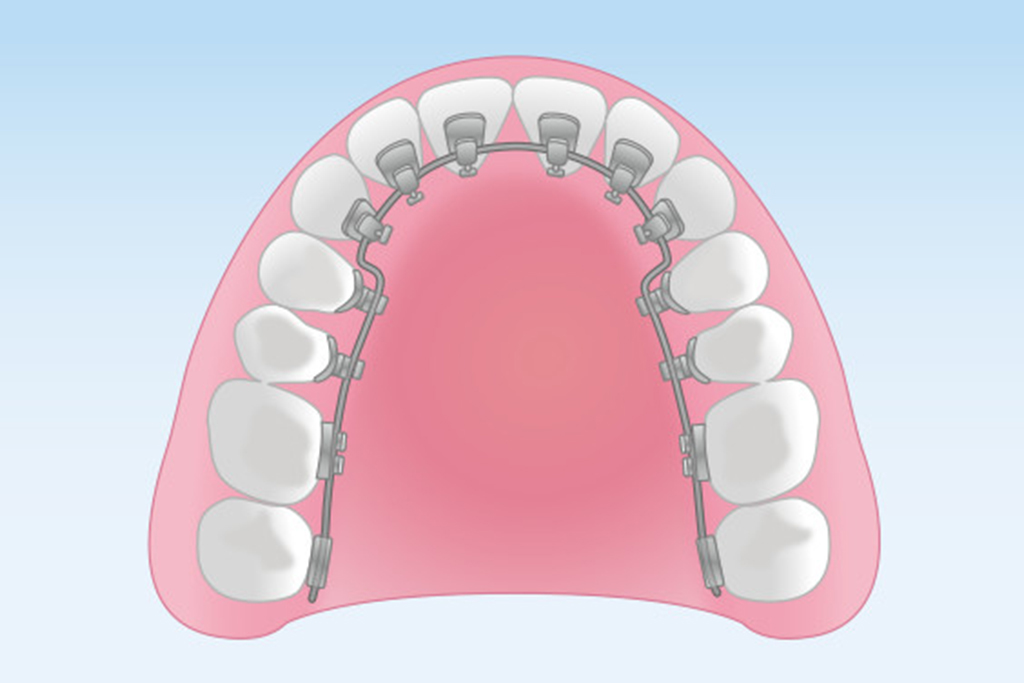 舌側矯正装置(フルリンガル)