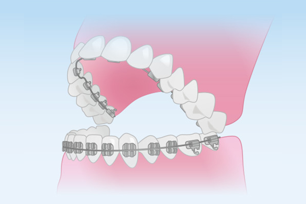 舌側矯正装置(ハーフリンガル)