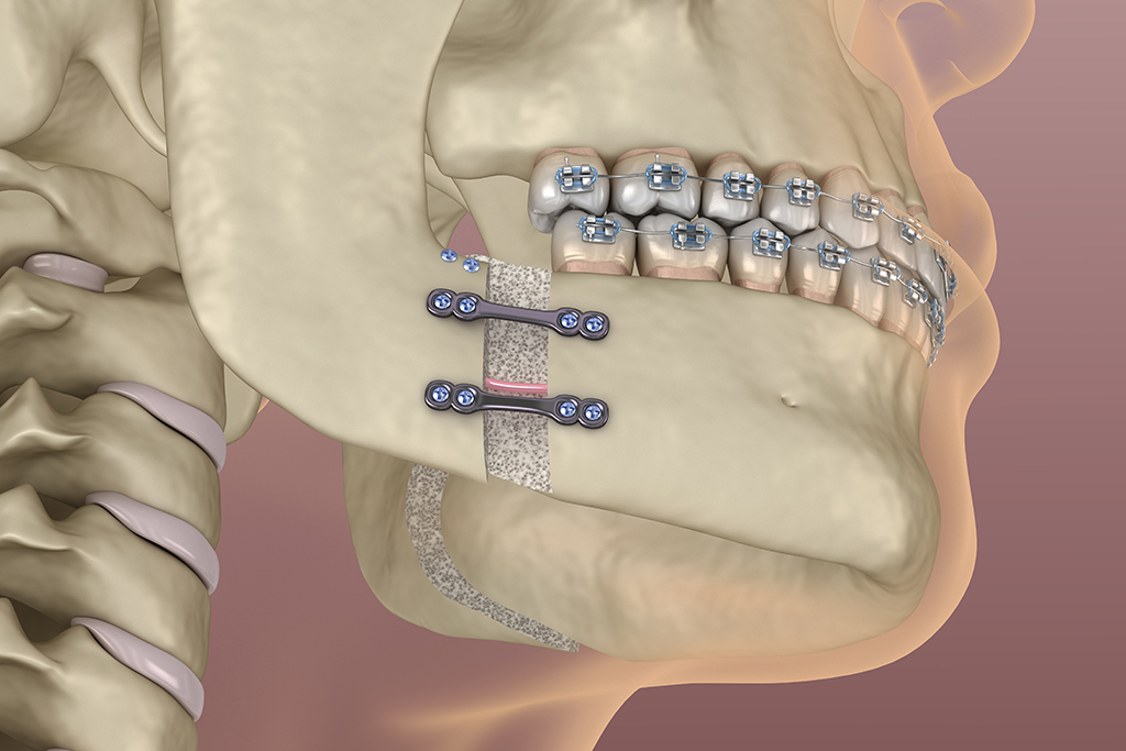保険適用の矯正治療