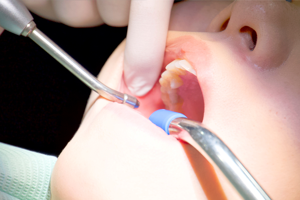 むし歯の治療